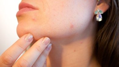 acne-gecae17f53_640